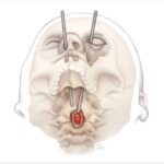 Transorbital Surgical Path to Spinal Chordoma